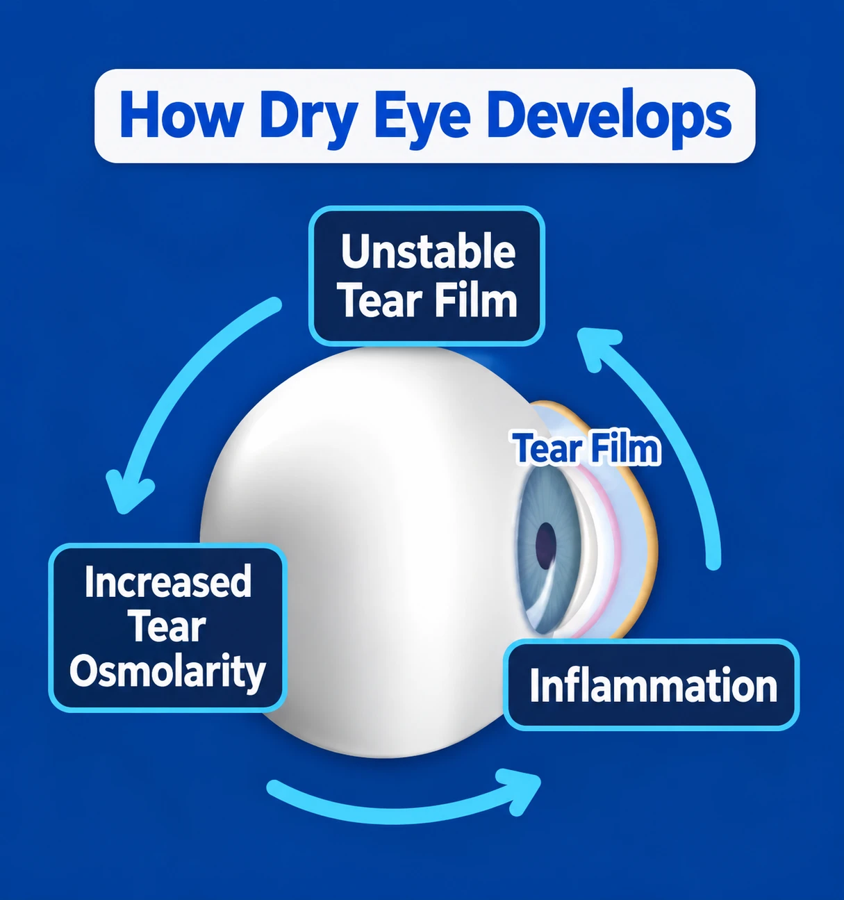 Cycle diagram showing unstable tear film, increased tear osmolarity and inflammation driving dry eye
