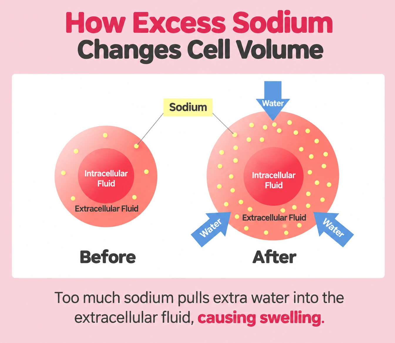 Diagram showing how excess sodium pulls water into extracellular fluid and causes swelling